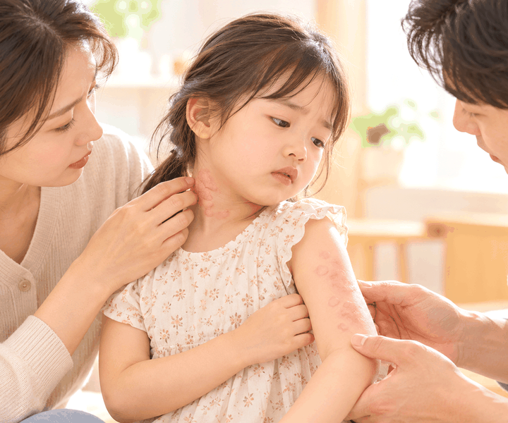 구리두드러기반복 – 팔에 나타난 붉은 두드러기와 가려움을 느끼는 아이